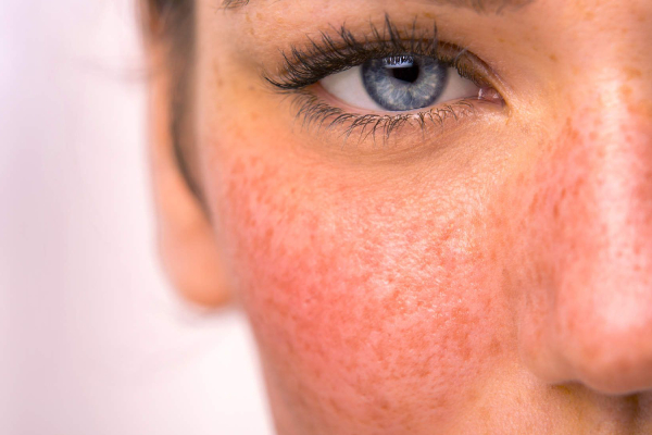 redness skin